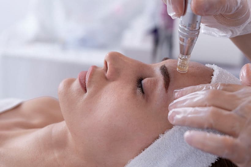 Microneedling