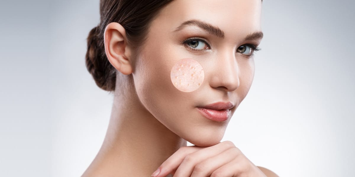 Milia Removal Treatment